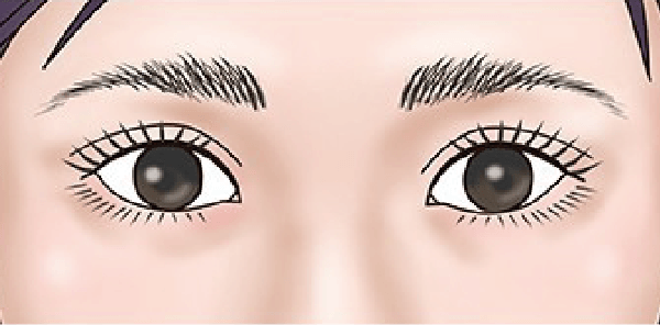 二重修正術 後の目元イラスト